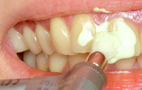 初診カウンセリング（矯正相談）